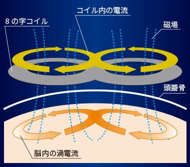 「TMS治療の原理」へ