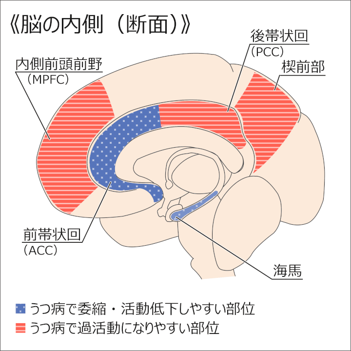 図：脳の内側（断面）／うつ病で萎縮や活動低下しやすい部位（青）：内側前頭前野（MPFC）・楔前部・後帯状回（PCC）; うつ病で萎縮や過活動になりやすい部位（赤）：前帯状回（ACC）・海馬