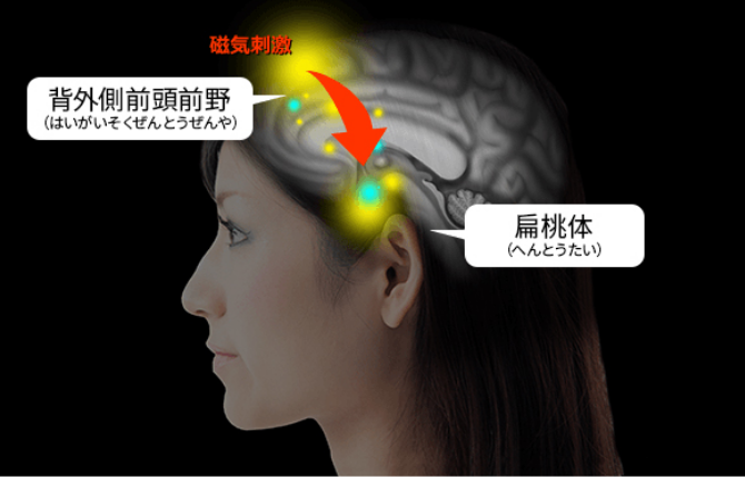 TMS治療説明画像